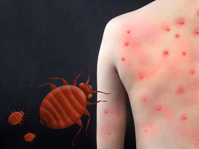 Puces de lits : 15 astuces pour s'en débarrasser définitivement